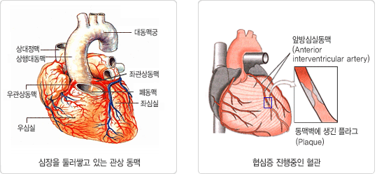 심장을 둘러쌓고 있는 관상동맥(대동맥궁,상대정맥,상행대동맥,좌관상동맥,우관상동맥,폐동맥,좌심실,우심실)과 협심증 진행중인 혈관(앞방심실동맥 Anterior interventricular artery, 동맥벽에 생긴 플라그 Plaque)