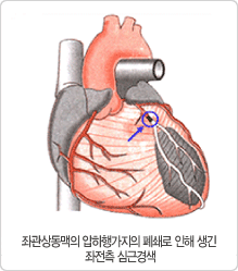 좌관상동맥의 입하행가지의 패쇄로 인해 생긱 좌전측 심근경색