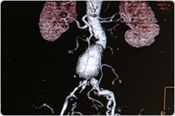 대동맥류 증상의 촬영사진